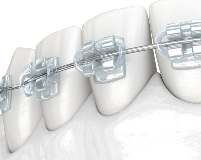 Tooth-colored ceramic braces that appear translucent on teeth.