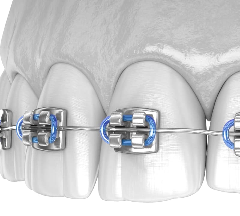 Traditional metal braces to straighten teeth.