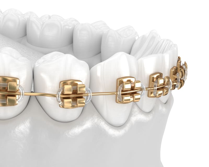 Gold braces to straighten teeth.